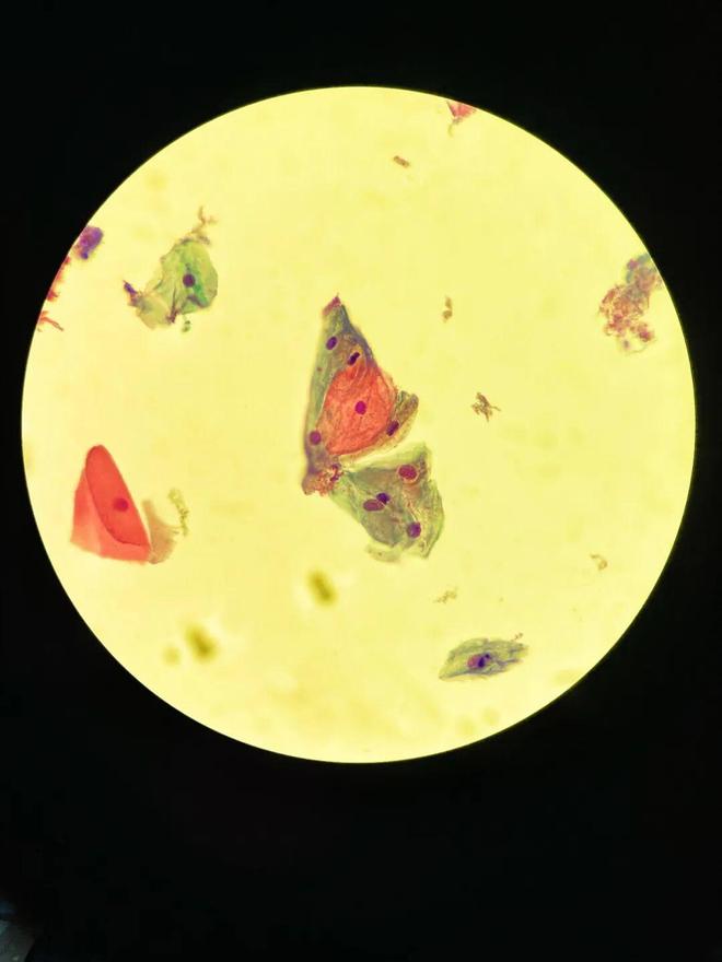 医艺相融！泰安市中心医院病理科侯巍巍深耕10年让病理切片成为会“讲故事”的画(图6)