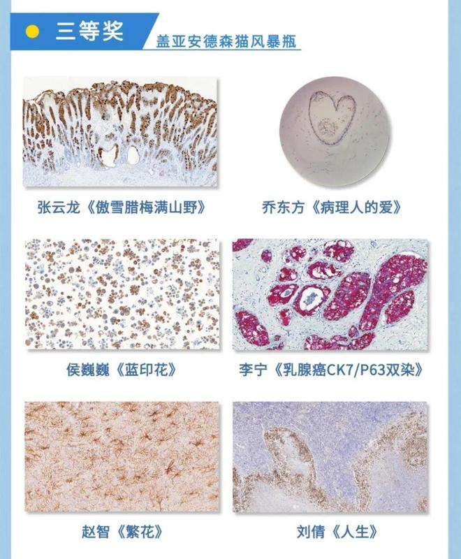 医艺相融！泰安市中心医院病理科侯巍巍深耕10年让病理切片成为会“讲故事”的画(图9)
